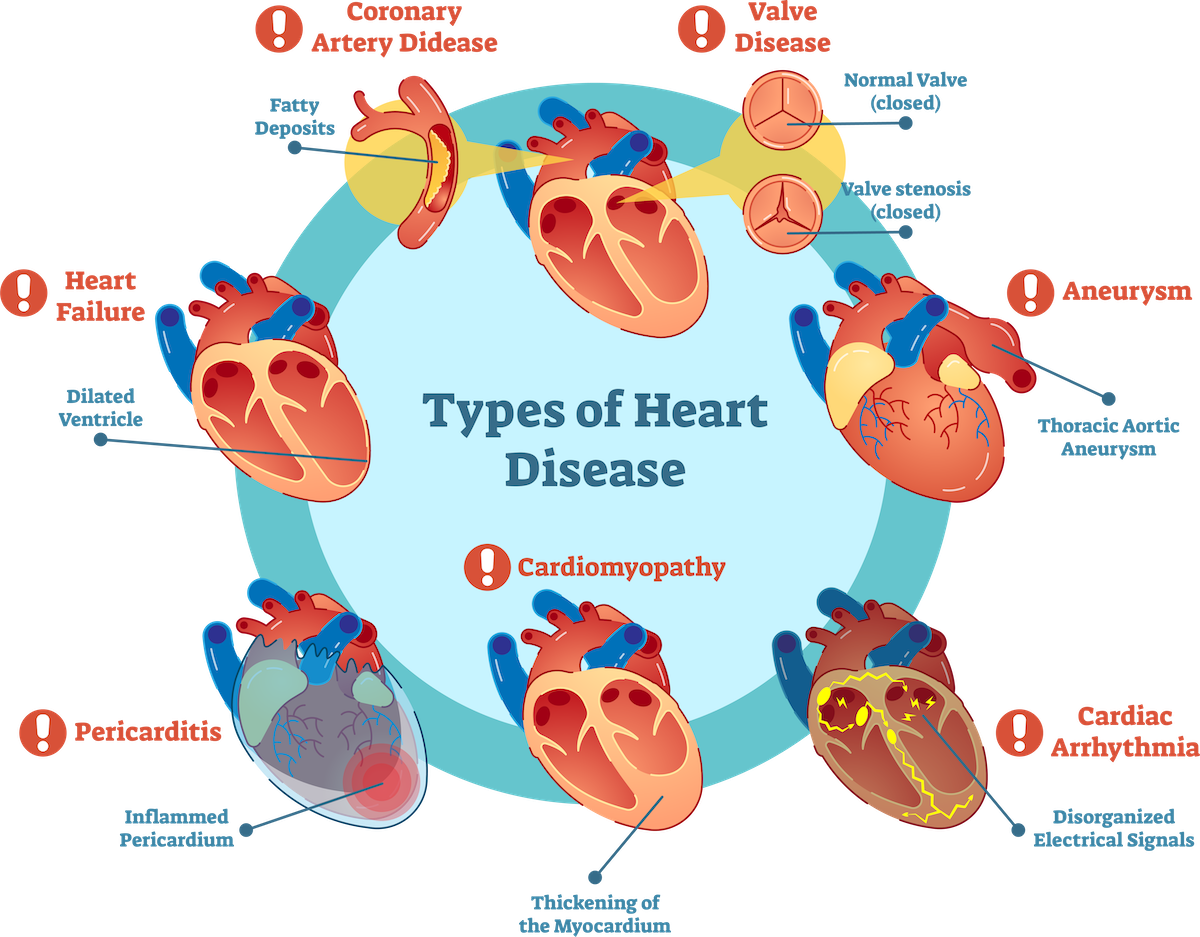 types of heart disease graphic; blog: Am I at Risk for Cardiovascular Disease?