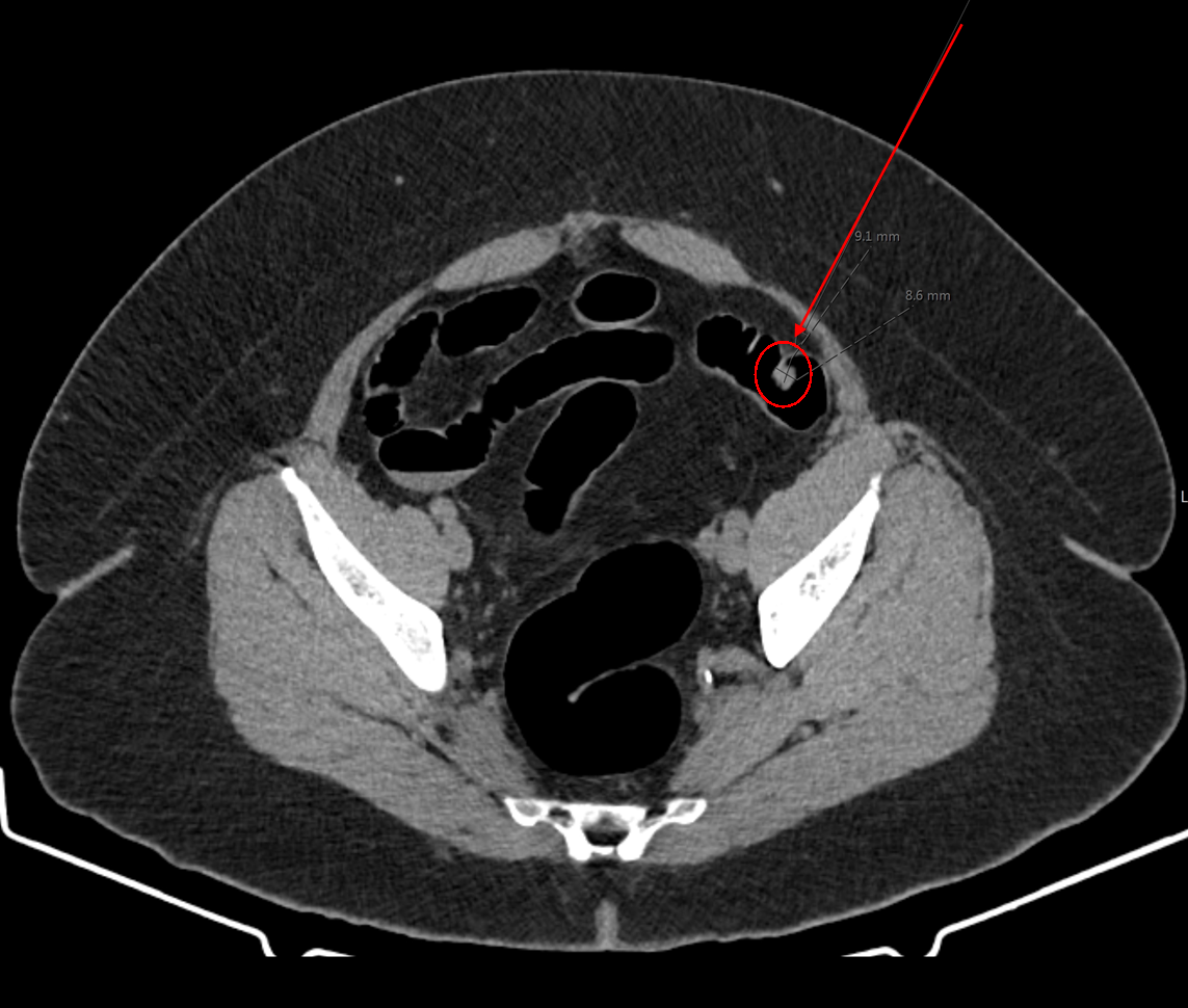 Virtual Colonoscopy Picture; blog: The Link Between High Blood Pressure and Kidney Disease